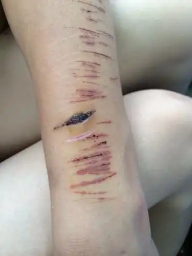 伤口是用折叠饰小剪刀割伤得 为什么伤口带红色 是破伤风吗?