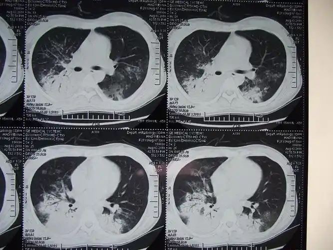 重症肺炎,肺结核