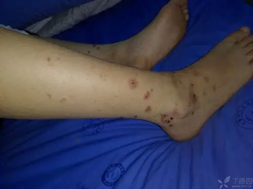 现在考虑变应性皮肤血管炎,目前四肢肌痛症状逐渐加重,血象