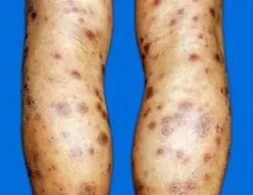 青岛皮肤病研究院解释如下:梅毒:早期梅毒症状表现为表皮疣状增生