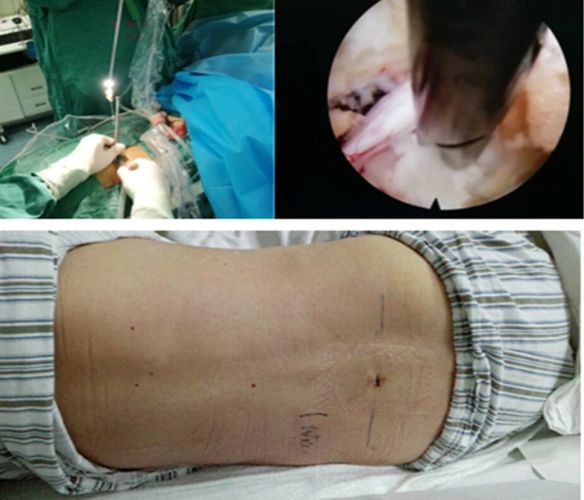 腰椎间盘突出症的微创手术治疗