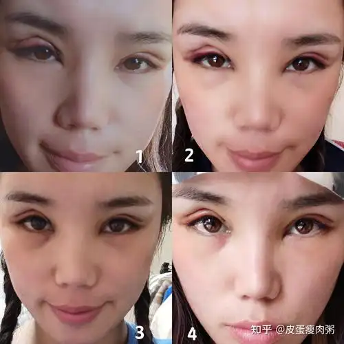 双眼皮失败了怎么办