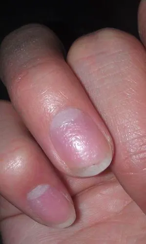 指甲是怎么回事,十个手指每个都有坑坑洼洼,时好时坏