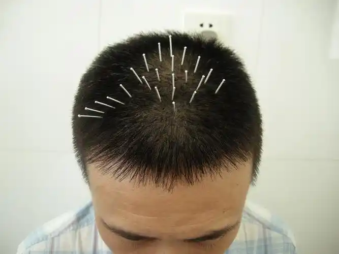 方氏头针-全息针灸与中医阴阳体系的完整结合 - 好大夫在线