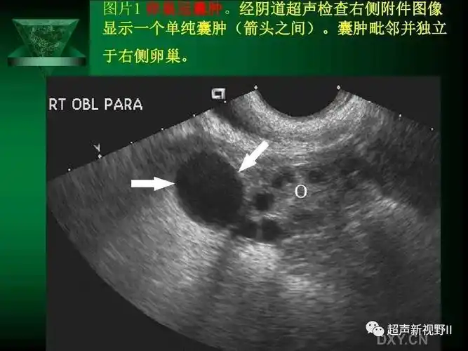 超声微课堂阴道超声检查规范