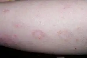 初期牛皮癣图片及症状治疗方法