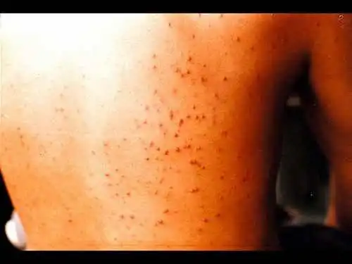 阴毛囊炎的症状