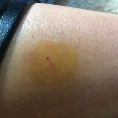 怀孕七个月,昨晚被老鼠抓成这样,去问了医生说不能打针,我改怎麼办啊?