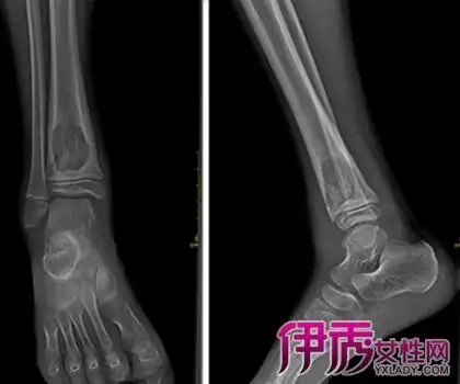 【图】脚踝滑膜炎的临床表现 为你盘点它的4种治疗方法