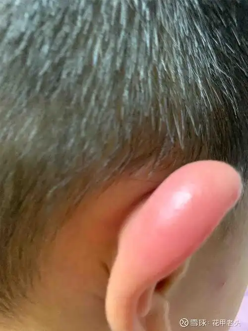 老家的蚊子真是毒把我小孙孙耳朵咬肿了