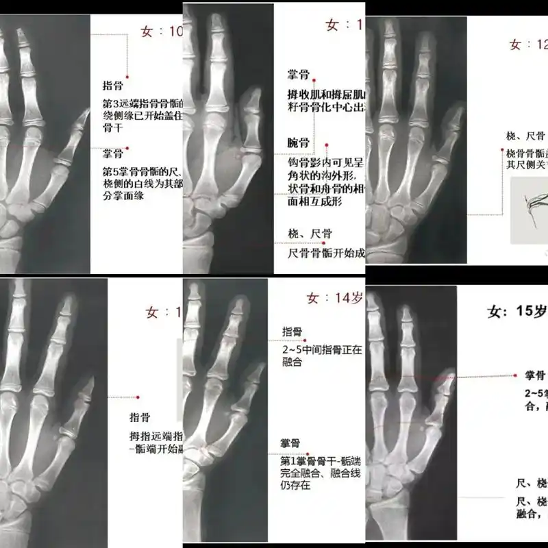 女孩10--15岁骨龄图片对照表  你家孩子骨龄多大了  欢 - 抖音