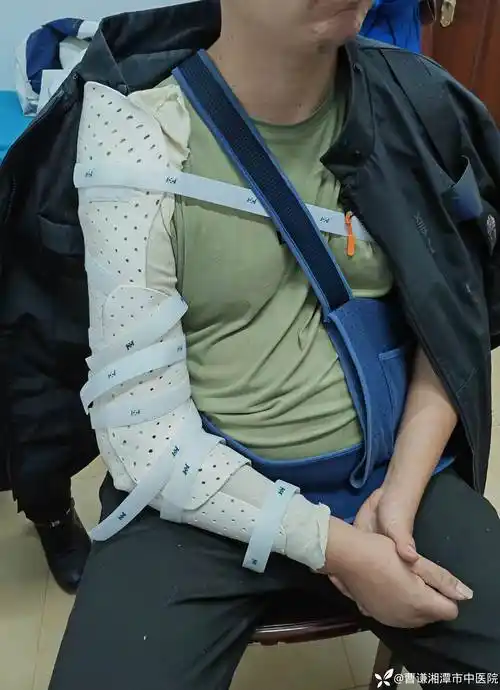 主任接诊了一个北京某知名三甲医院治疗四十余天的陈旧性肱骨干骨折