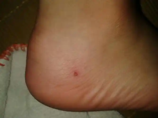 鄙人怀疑脚被耗子咬伤,希望大家帮我辨别下,让我安心.