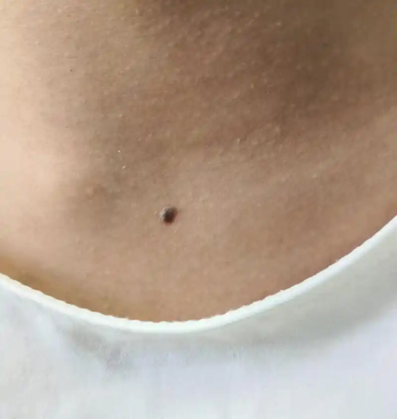 常见的黑色素痣分类 黑色素痣是我们非常常见的一种色素痣,每个人从