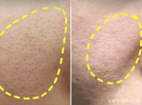 脸上毛孔粗大就像是"橘皮",难看又坑洼,简单3招,告别大毛孔