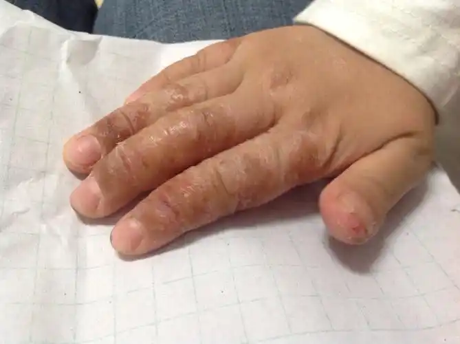 小儿手部顽固皮肤病.