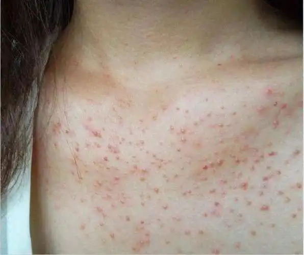 马拉色菌毛囊炎(一) 马拉色菌是哪里来的糠秕马拉色菌是人体皮肤常驻