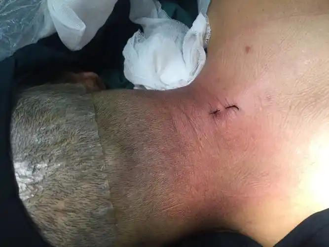 后路椎间孔镜治疗颈椎管中央狭窄一例