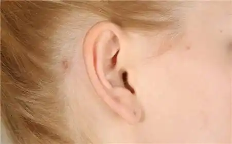 什么是鸡嘴耳?