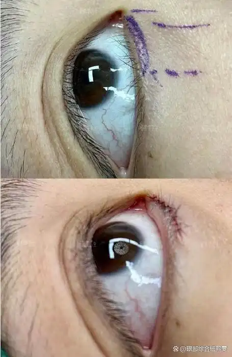 倒睫是指睫毛生长向后方倒向眼球的状态,倒睫是眼科最常见的眼部外