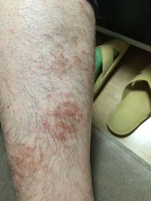 每到冬天天冷的时候 腿皮肤就会很痒 出红斑一样的