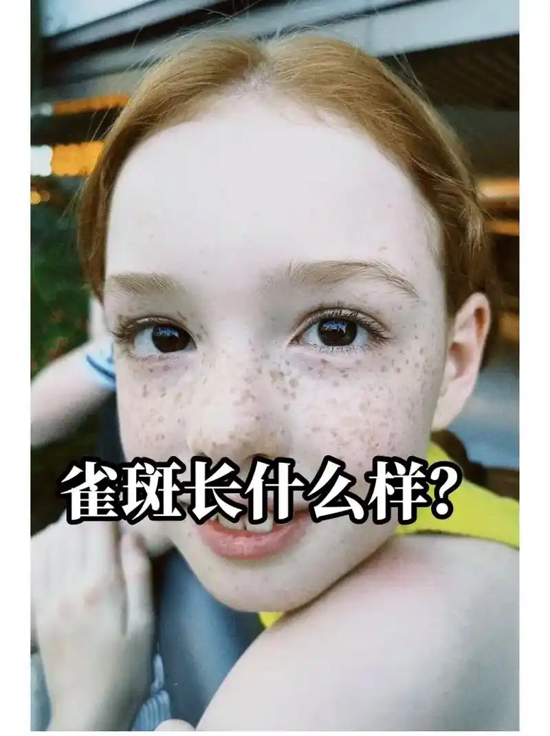 斑美宜-雀斑长什么样?#美业知识分享,雀斑是一种定型斑,长在 - 抖音