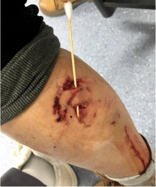 查看)近日,张某与王某(均为化名)务工时被大狗(后证实为"马犬")咬伤