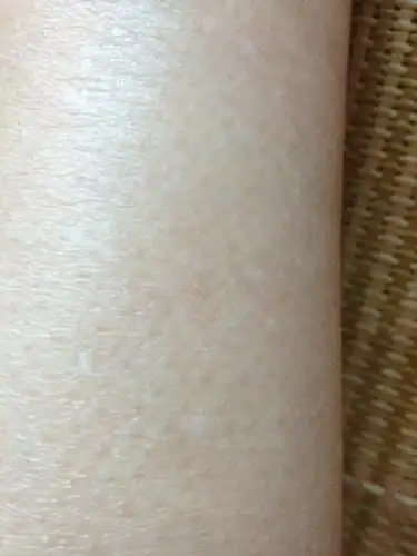 问:脚上这个白白的点点有两三年了越长越多 怎么回事