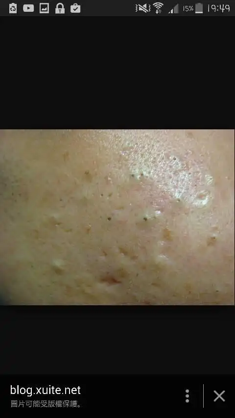 图片为网上图片 黑色点点的粉刺怎样消除?