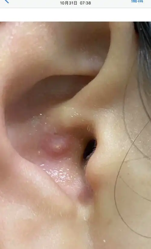 怎样对付外耳道的疖肿? - 知乎