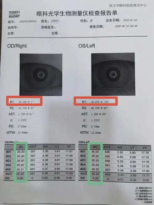 这类近视人群更需要重视--角膜代偿性近视