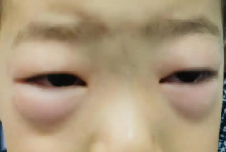 孩子突然眼睛红肿怕不怕