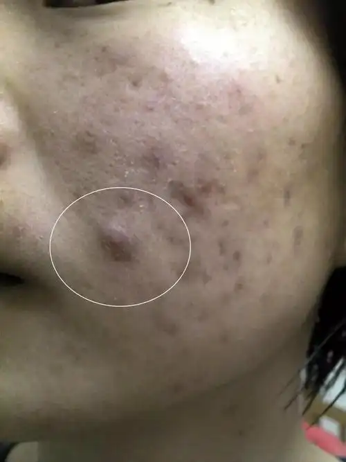 这些组织 过度增生,就会形成硬硬的结节,也就是结节型痘痘