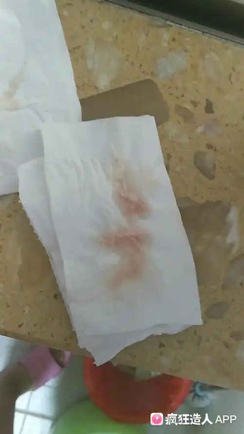 [试管婴儿]移植16天流血,两次都这样,这样流血是不是完了