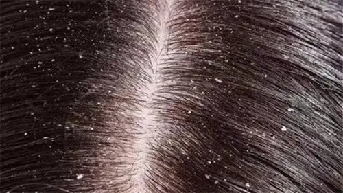 成都金牛区养老院一暄康养提醒十大令人尴尬的健康问题(3)-头皮屑1