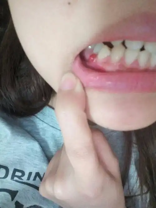 牙龈上一直有个泡,有时候上火会大,从来没下去过,这是个什么啊?