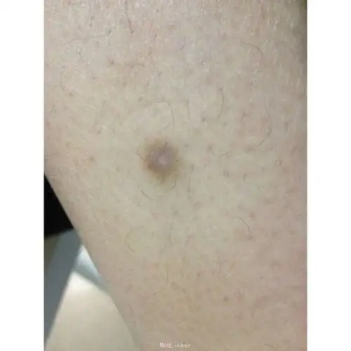 下肢皮肤纤维瘤一例-医联