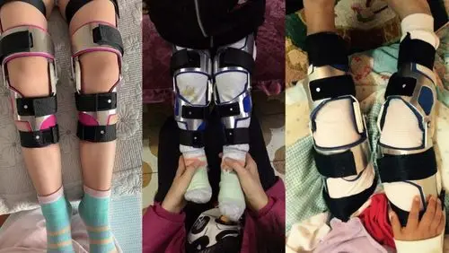 儿童罗圈腿矫正