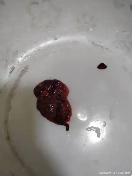 怀孕62天自然流产图片是流出来的物质应该是胚