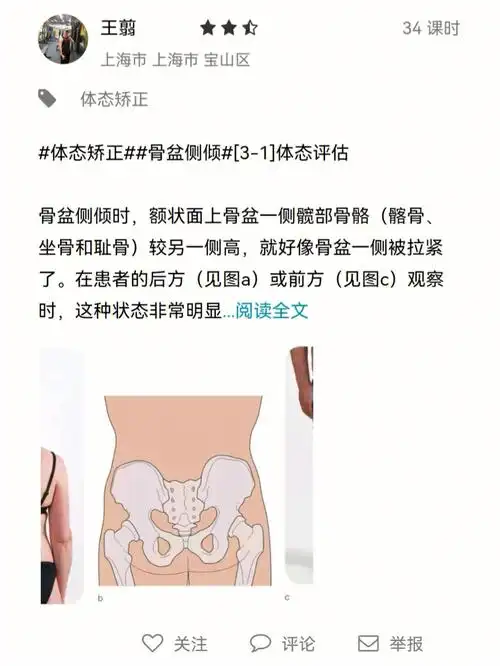 体态矫正骨盆侧倾