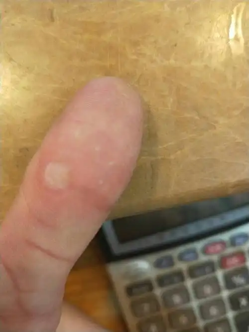 急眼还是鱼休子?越来越大.原来挑过,没有挑完,越来越大了