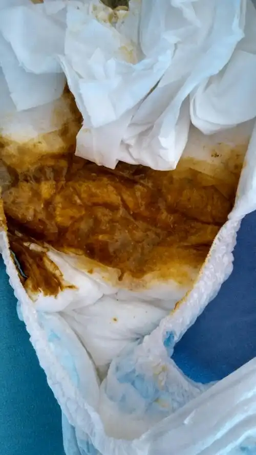 我的宝宝最近拉粑粑是这样的稀稀的!咋回事啊!算是重?