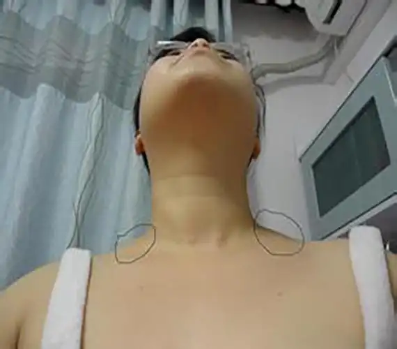 甲状腺肿大有什么症状的图片