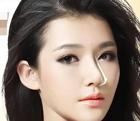 隆鼻有什么风险?关于隆鼻的知识,这些事情一次性告诉你!