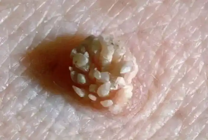 冠状沟珍珠疹图片珍珠疹龟头炎图片