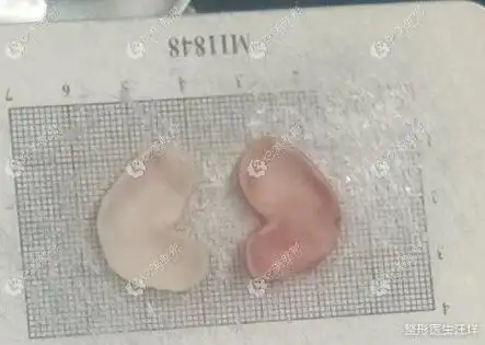 汪垟鼻综合恢复日记:双侧耳软骨 硅胶假体术后对比照整形案例 - 北京