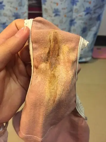 你好,白带异常可能是妇科炎症导致的症状,建议淡盐水勤洗局部,避免吃i