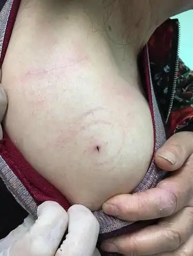 专家提醒春暖花开外出游玩季注意防范蜱虫叮咬