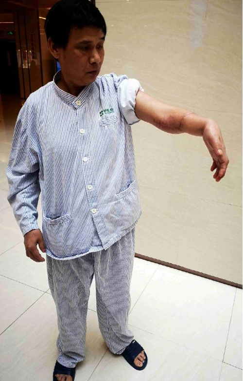 广州祈福医院完成高难度断臂再植手术