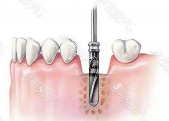 种植牙打桩步骤流程